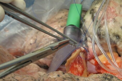 An atrial cuff into a set of human lungs to check their suitability for transplant. 