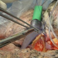 Lung transplant patients who had to go to the UK can now stay in Ireland