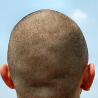 Man accused of shaving head and taking weight loss pills to fake cancer