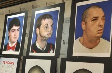 US man successfully undergoes world's most extensive face transplant