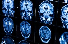 People with epilepsy 11 times more likely to die prematurely