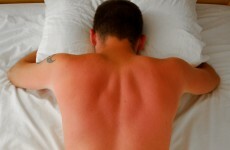 Put away the aftersun: scientists may have found an end to sunburn pain