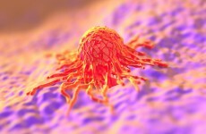 Well-off 'more likely to have cervical cancer screening' - except in Northern Ireland