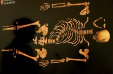 Richard III suffered from roundworm infection