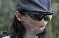 US hospital gives man new nose, lips, skin and muscles in face transplant op