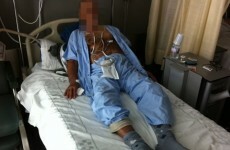 Man gets penis amputation after taking too much Viagra