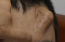This man is growing a nose on his forehead