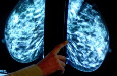 Global survey shows advanced breast cancer patients are battling isolation