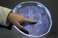 Drug tests make Alzheimer's treatment 'a real possibility'