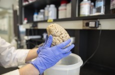 Gene mutation speeds up brain decline in Alzheimer's