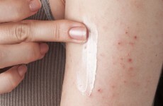 New genetic mutation linked to eczema