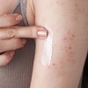 New genetic mutation linked to eczema
