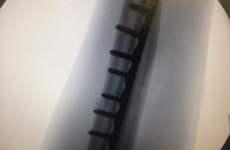 Here's what Rory Best's arm looks like following surgery