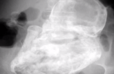 Doctors find elderly woman's stomach pain is a 40-year-old foetus