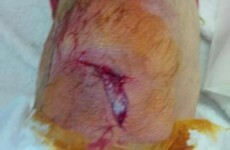 Snapshot: Laurent Koscielny has got a nasty gash on his knee