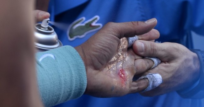 Rafael Nadal has got seriously nasty blisters on his hand
