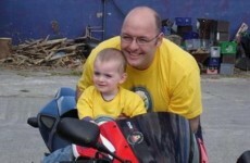 Irish boy, 2, 'recovering well' after pioneering brain surgery