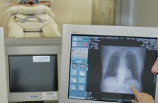 New way to avoid risky biopsies in diagnosis of deadly lung disease