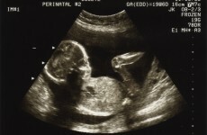 Quarter of miscarriages "could be prevented" by lifestyle changes