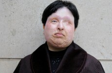 Blinding of Iranian criminal with acid 'postponed'