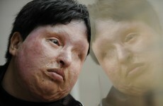 Poll: Would Iran be right to blind criminal with acid in 'eye for an eye' justice?