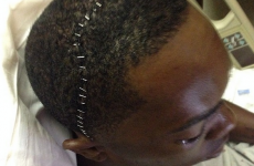 MLB pitcher stapled back together after taking ball to the head