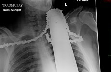 Incredible X-ray shows chainsaw stuck in man's neck