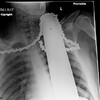Incredible X-ray shows chainsaw stuck in man's neck