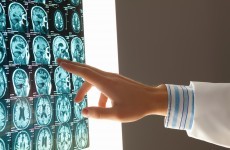 Patients in a vegetative state are often misdiagnosed, but a new brain scan may help