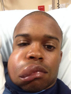 Baseball star shows off severely swollen face after being struck by 90mph fastball