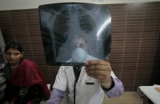 As TB re-emerges, a link is found to low vitamin D in children