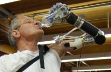 Mind-controlled prosthetic arm approved by US medical authorities