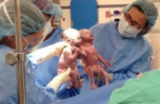 Hand-holding 'mono mono' twins released from hospital in time for Father's Day