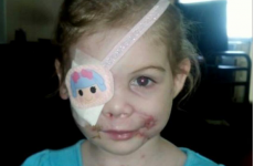 Little girl kicked out of KFC over scars was a hoax, investigators claim