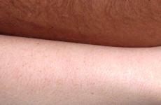 10 problems only people with Irish skin must face