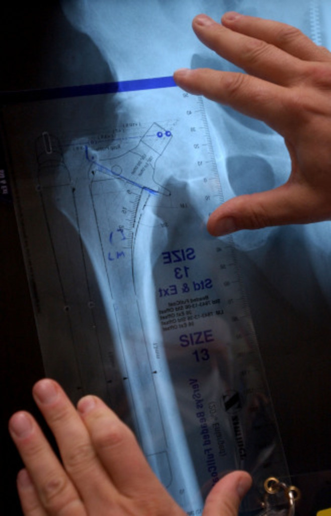 Hip replacement devices recalled · TheJournal.ie