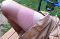 16 horrifying sunburn patterns to avoid during this heatwave