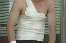 Teens are setting themselves on fire as part of a 'Facebook challenge'