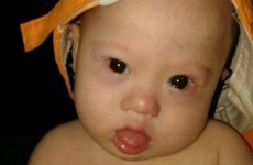 Parents 'abandoned' baby with Down syndrome born to surrogate