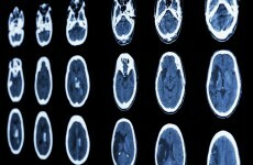 "Every minute counts." - Study shows why treating strokes immediately is vital