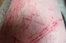 Gerry Adams really did a number on his legs while cutting hedges