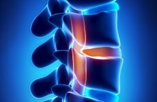A 3D printed vertebra was used to fix a boy's spine