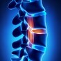 A 3D printed vertebra was used to fix a boy's spine