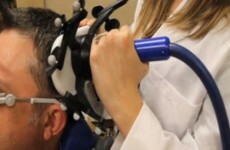 Sending electrical current to brain could help treat Alzheimer's