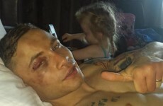 Carl Frampton may have broken his hand in the middle of Saturday's world title win