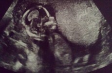 Samantha Mumba and Una Foden chose THE WORST day to reveal baby news