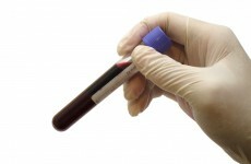 "Too many" with haemophilia in Ireland have died