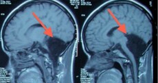 A woman was missing part of her brain for 24 years - and nobody noticed
