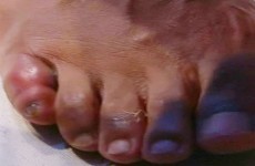Did this broken toe cause David Haye to lose last night's heavyweight dust-up?