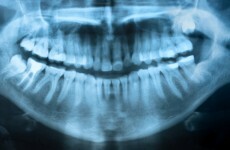 'DNA is sexy' but dental records most useful for identifying bodies